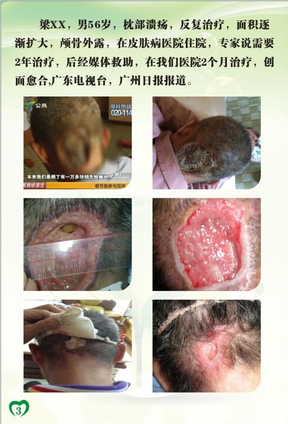 中医特色治疗-坏疽性脓皮病(图2)